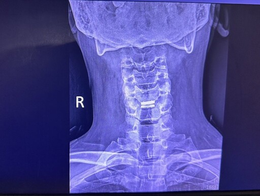 影音/低頭滑手機注意頸椎受力 重視預防與適當治療遠離頸椎病變