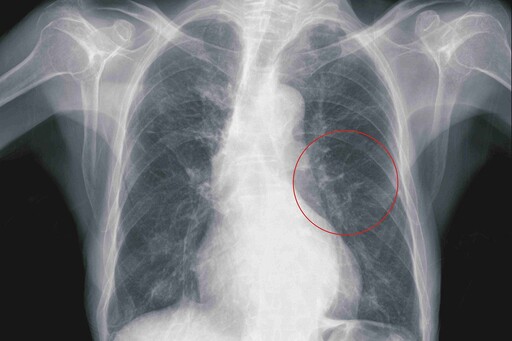 彰基守護每一位肺疾患者健康 舉辦健康講座 病友更細緻瞭解肺癌治療