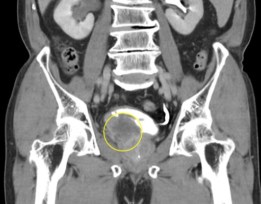 七旬翁血尿不辭千里求診 揪出膀胱癌 即時手術保健康