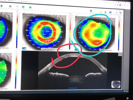 舊式近視矯正術後遺症頻發?信賴眼科有解 引進義大利新儀器「角膜斷層掃瞄儀」