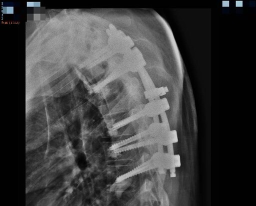 男車禍脊椎骨爆裂性骨折 重症整合加愛情挽癱瘓之危
