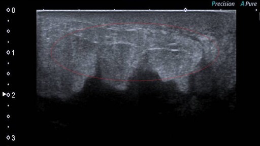 婦女乳房腫脹疼痛 檢查醫師發現竟是罕見的肺癌轉移