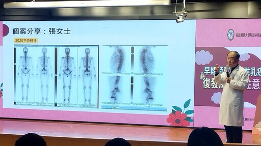 高醫揭乳癌「五年過關」是假象 荷爾蒙陽性乳癌需長期監控