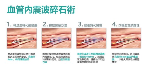 震波碎石心導管術 安泰醫院成功打通鈣化血管救心臟