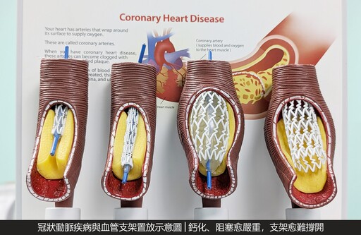 震波碎石心導管術 安泰醫院成功打通鈣化血管救心臟