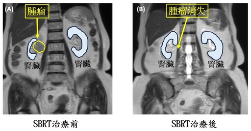 SBRT療法戰勝罹癌憂懼 助高齡患者消除腎臟腫瘤