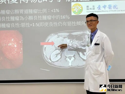 男子腹腔5公分腫瘤竟是罕見免疫疾病