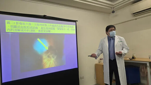 婦人視力變差 原來是賀爾蒙過量惹的禍