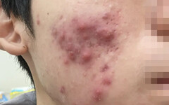 面對青春痘別輕忽 醫提醒把握治療黃金期