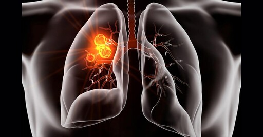 Lorlatinib肺癌新藥試驗 6成病患5年未惡化