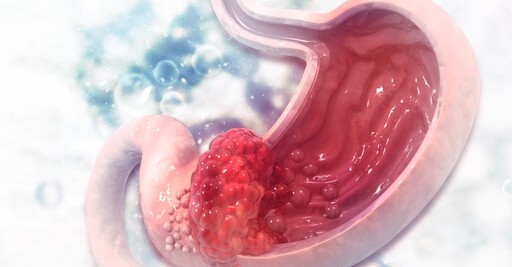 中國檢測胃癌新技術 準確率高達90%