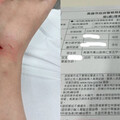被狗咬到腳「噴血噴整隻腳」 飼主囂張嗆：沒錢賠