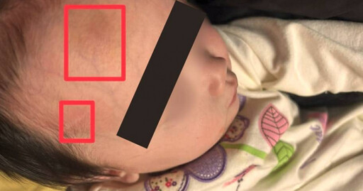 1歲兒送安置機構竟出現瘀青家長怒控虐待 社會局：傷勢原因仍待評估