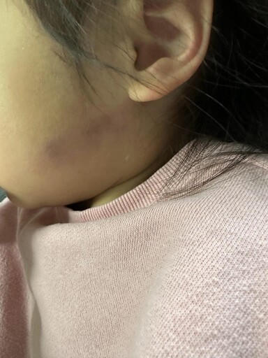 竹縣幼兒園爆虐童！3歲女娃雙耳紅腫瘀血 家長控：要看監視器卻壞了