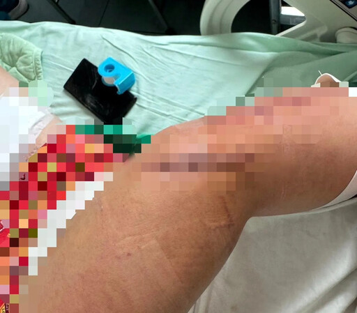 台南仁德服務區驚見隨機砍人! 肌腱斷裂全身中多刀