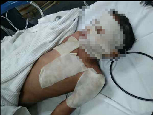 鄰居買小蘇打粉通水管!竟引爆樓下廚房爆炸 9歲男童「毀容恐失明」