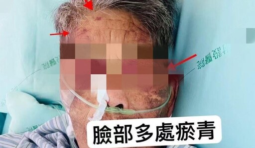 影/台中嬤莫名「瘀青」滿身傷 家屬驚見看護揮打氣炸