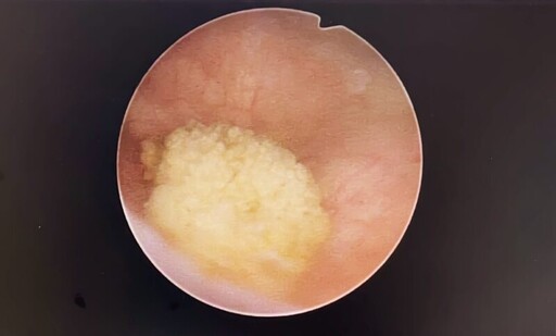 多年沒追蹤的結石病人突然困難排尿 醫執行鈥雷射碎石避免造成腎損傷