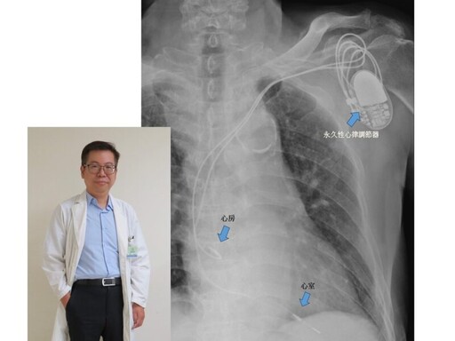 高血壓伴心律不整隱患 民生醫院:小心房室阻滯