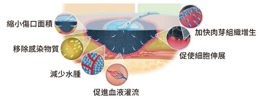 民生醫院:負壓傷口治療加速癒合