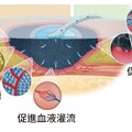 民生醫院:負壓傷口治療加速癒合