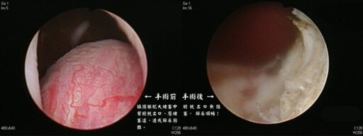 熟男腹脹如懷孕？ 醫診斷竟是攝護腺「中葉」肥大阻尿流險引發尿毒症