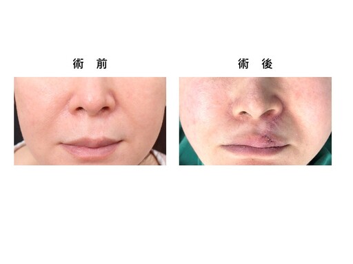曹賜斌醫師獨創白疤再生術 助患者揮別童年傷痕回歸正常生活