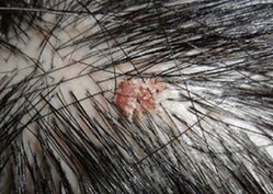 阮綜合醫劉昭宏籲：炎夏頭皮毛囊炎激增2成 全罩式安全帽族群要當心