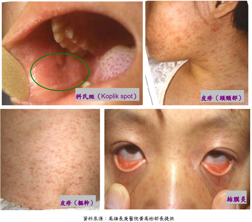 近期國外麻疹疫情嚴峻 連假出國要注意麻疹疫情