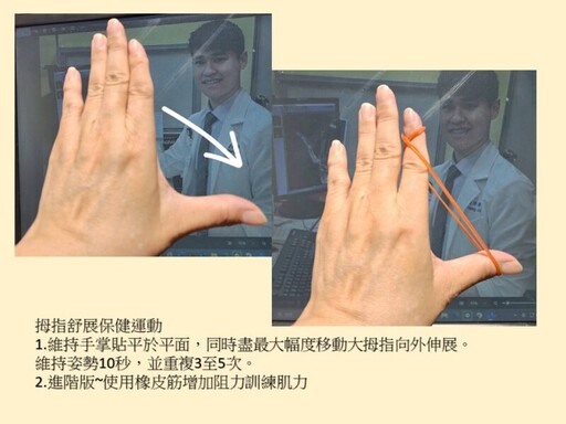 拇指腕掌關節炎年輕化！阮綜合醫院助患者術後重返職場