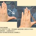 拇指腕掌關節炎年輕化！阮綜合醫院助患者術後重返職場