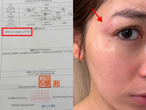 東區知名髮廊變凶器?!大馬女星劉倩妏曬燙傷照控訴:店家冷血神隱