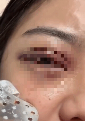 【獨家】新北中和驚傳情暴案!恐怖情人失控爆擊致女方左眼水晶體脫落幾乎失明 中和警火速拘提到案建請聲押禁見