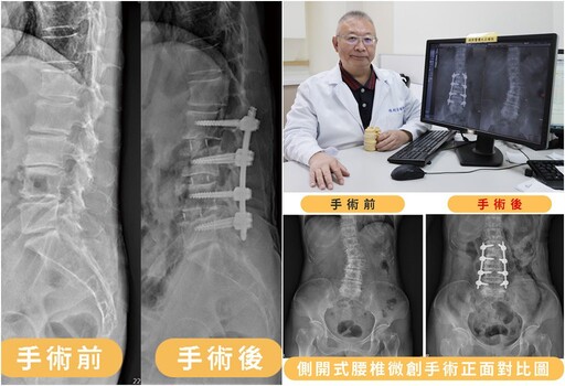 影音∕側開式腰椎微創手術 治癒八旬嬤背痛與駝背