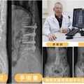 影音∕側開式腰椎微創手術 治癒八旬嬤背痛與駝背