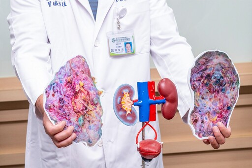 影音/切除6公斤多囊腎 彰基活腎移植助教師重返講台