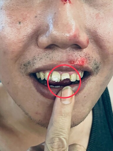 桃園大廟前纜線外露變陷阱!男慘摔斷門牙腦震盪