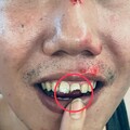 桃園大廟前纜線外露變陷阱！男慘摔斷門牙腦震盪