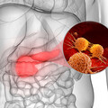 作家小彤胰臟頭出現2.3公分惡性腫廇！為什麼「胰頭」手術比「胰尾」複雜？
