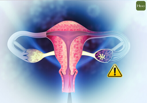 卵巢癌發展快易致命！婦癌權威破解卵巢癌治療 5 迷思