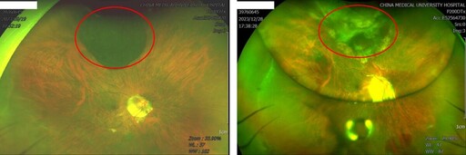 惡性黑色素瘤手術免摘眼球 中國醫大附醫成功保留眼球視力