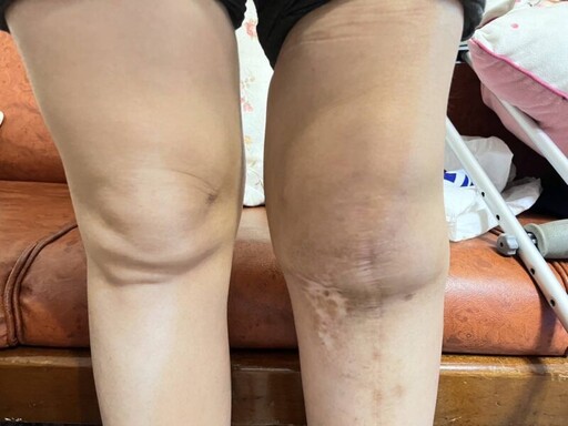 搬家後膝蓋〝腫成麵龜〞 30歲女專程南下尋醫 「重燃膝望」